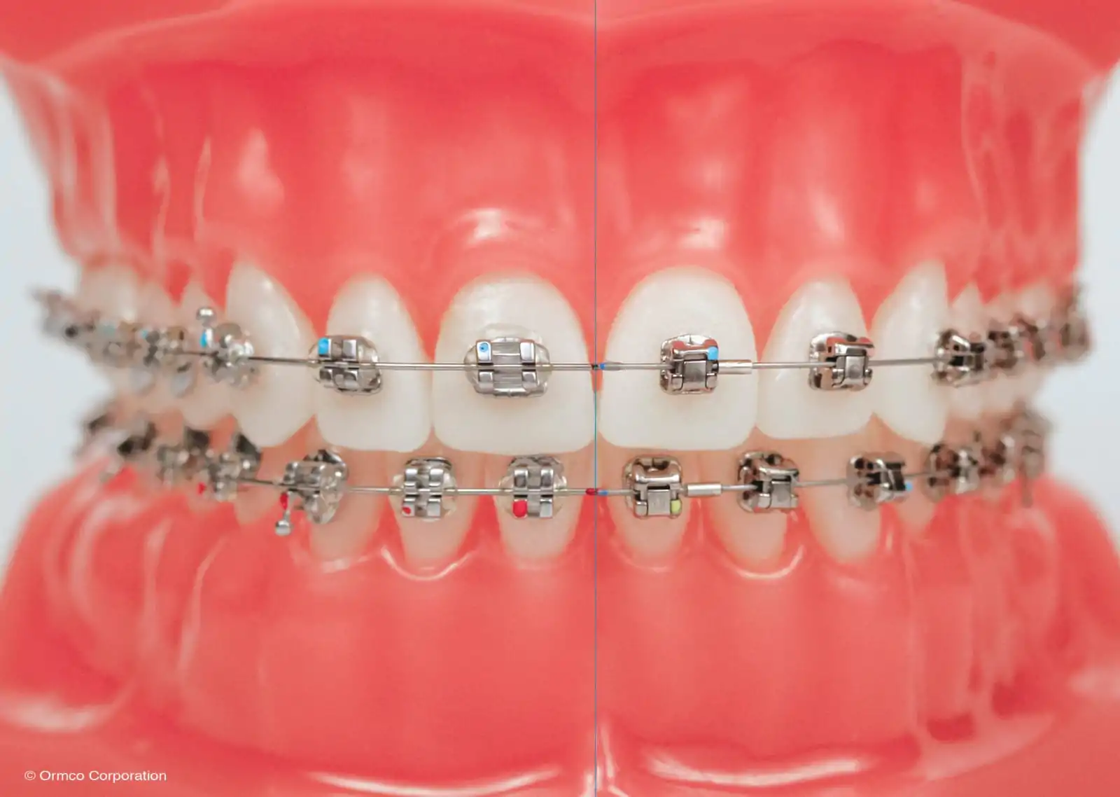 tratamento-aparelho-autoligado-daemon