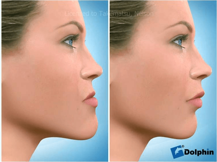 tratamento-preparo-ortodontico-para-cirurgia-ortognatica